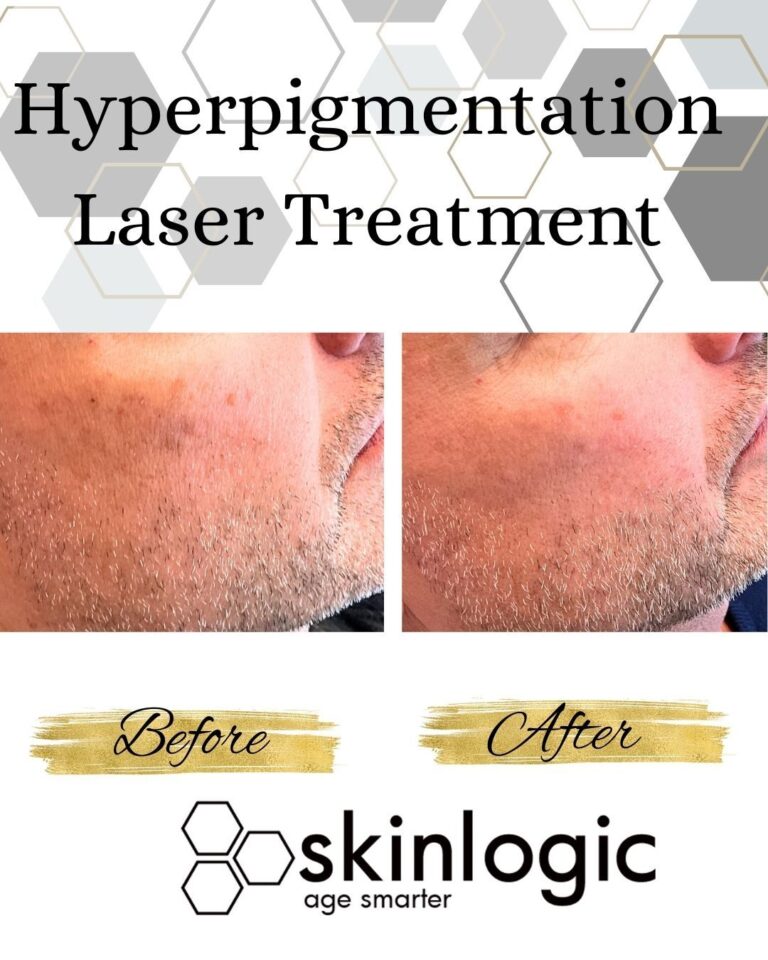 before and after spot hyperpigmentation laser right side view male patient Maryland