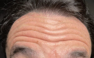 before Botox forehead front view case 1310