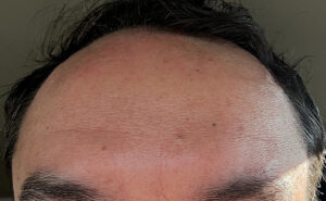 after Botox forehead front view case 1310