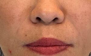 after dermal fillers front view case 959